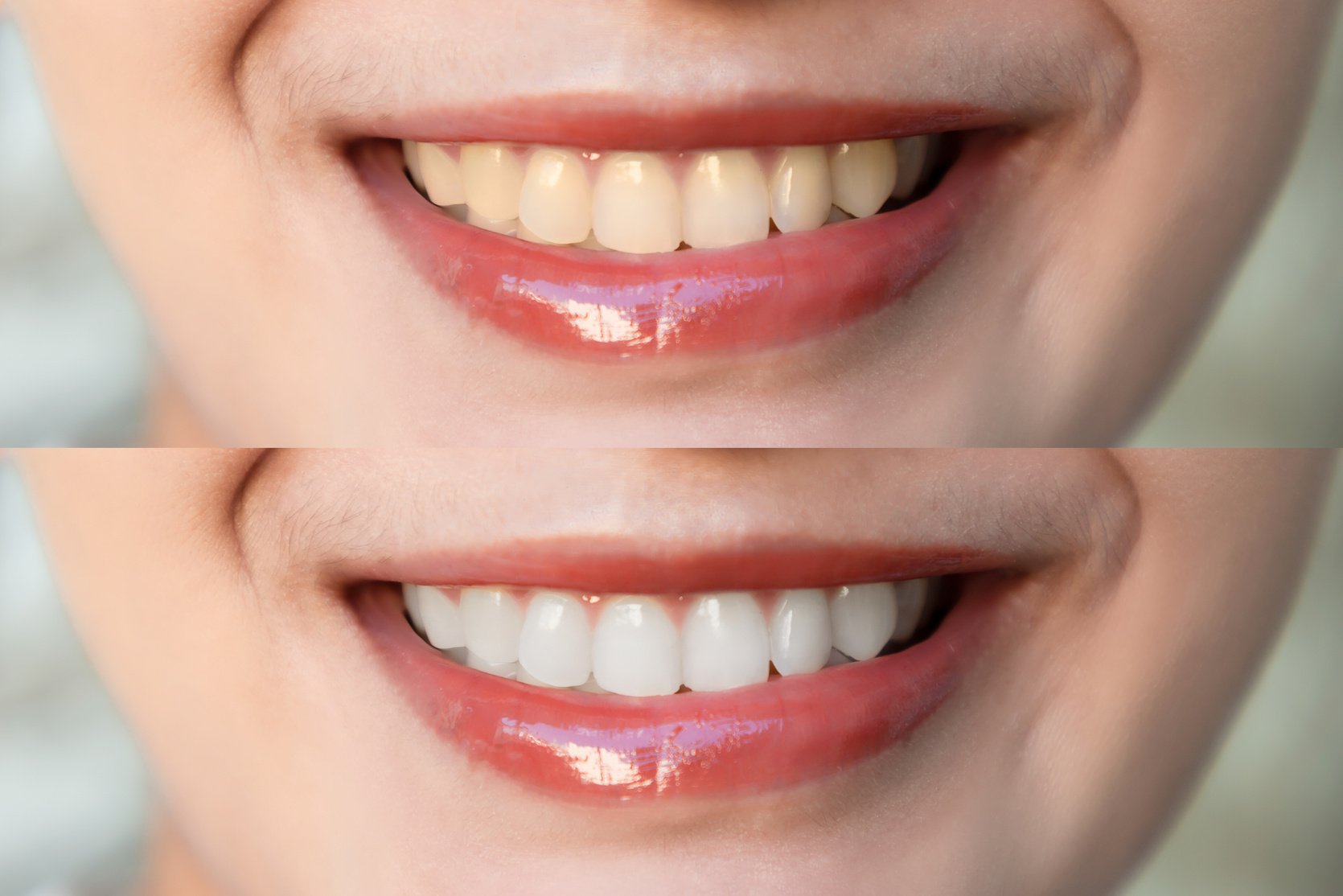 Woman teeth before and after whitening. Looking at camera. Denta