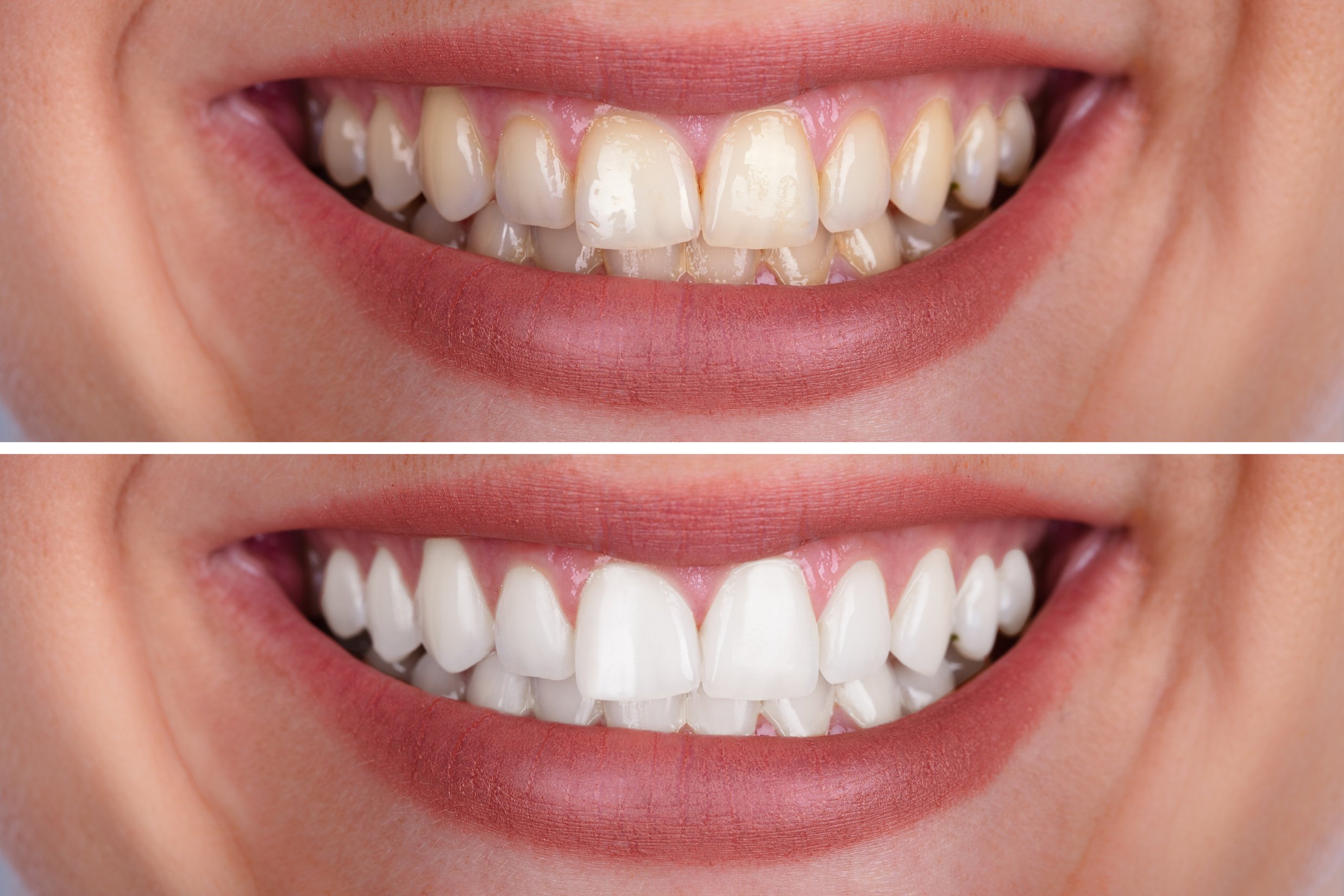 Woman's Teeth Before And After Whitening