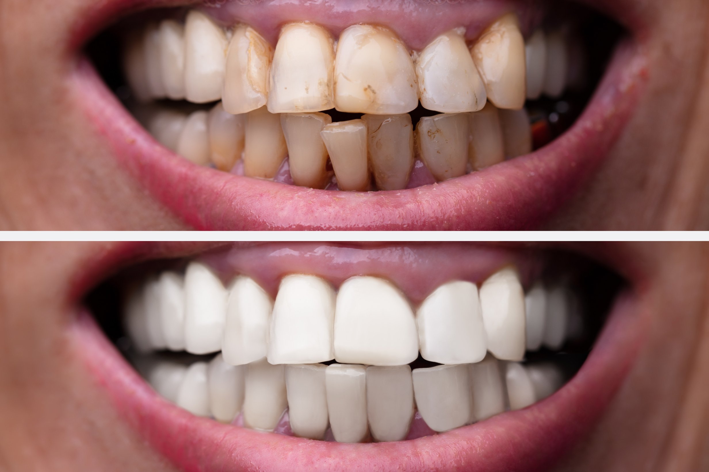 Woman Teeth Before And After Dental Treatment