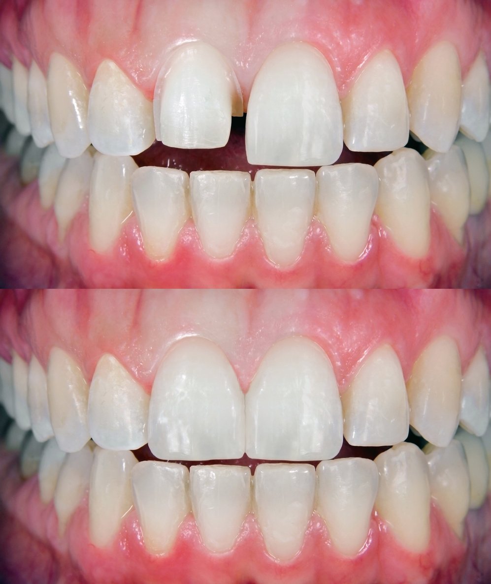 Before & After Dental Veneer