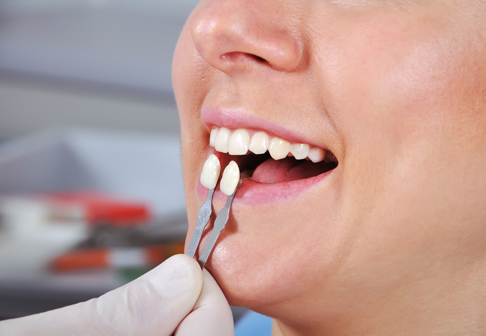 Teeth Matching for Veneers